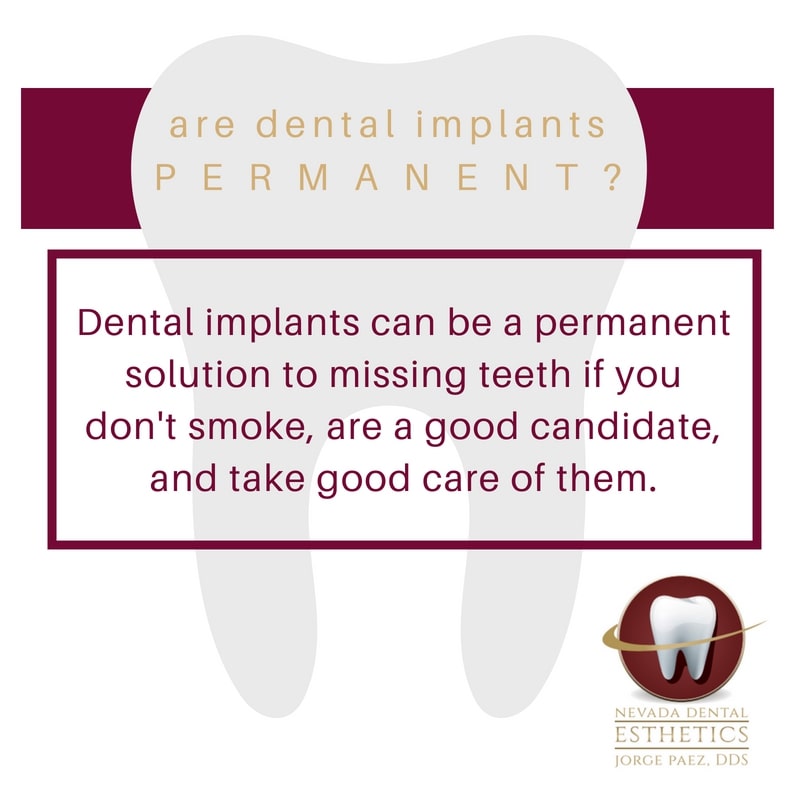 Tooth Implants Spring Valley NV