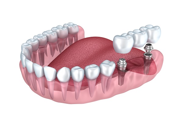 illustration of lower teeth with set of implants being placed on rear teeth