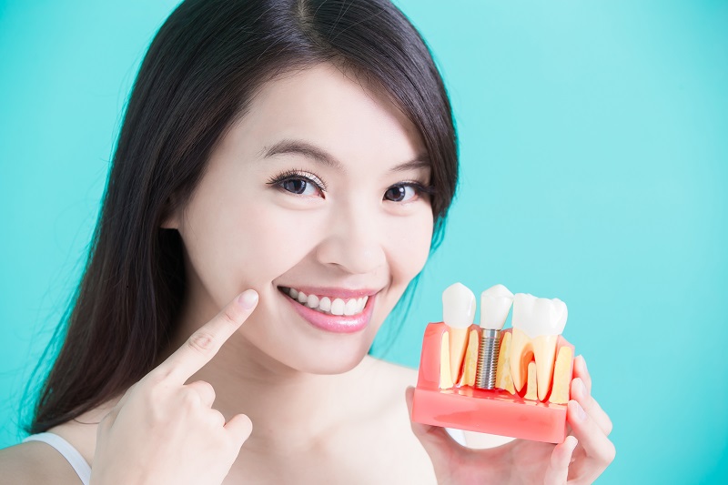 dental implants las vegas NV