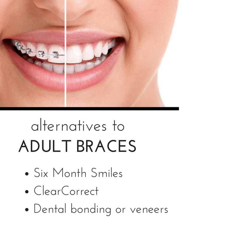 do you need braces as an adult 626a855f01f93