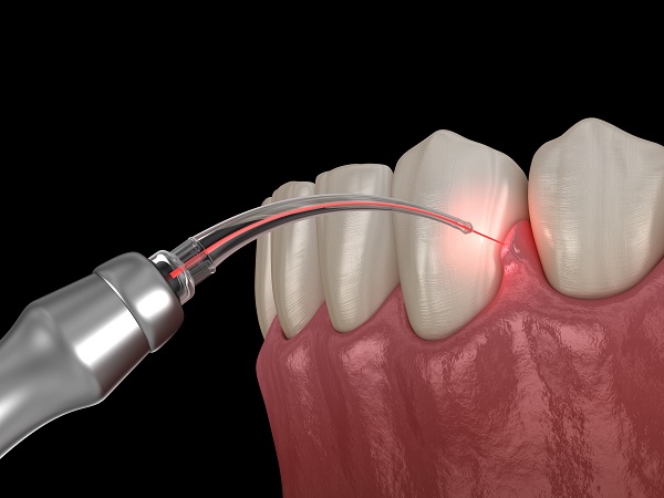 laser dentistry Las Vegas NV