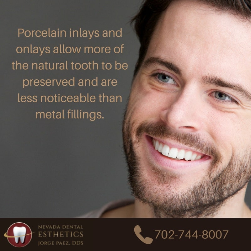 Porcelain Inlays & Onlays Fillings Las Vegas NV