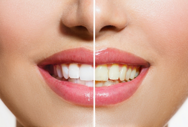 Teeth Whitening Las Vegas NV