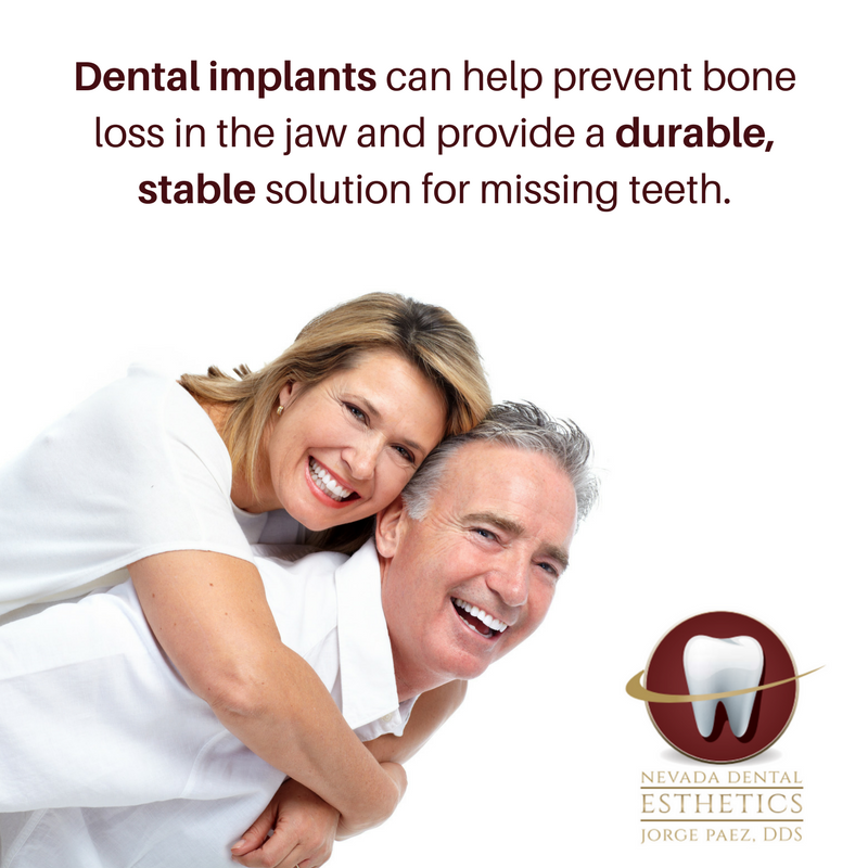 Dental implant benefits 