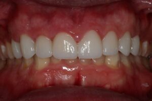 After Image: Crowns