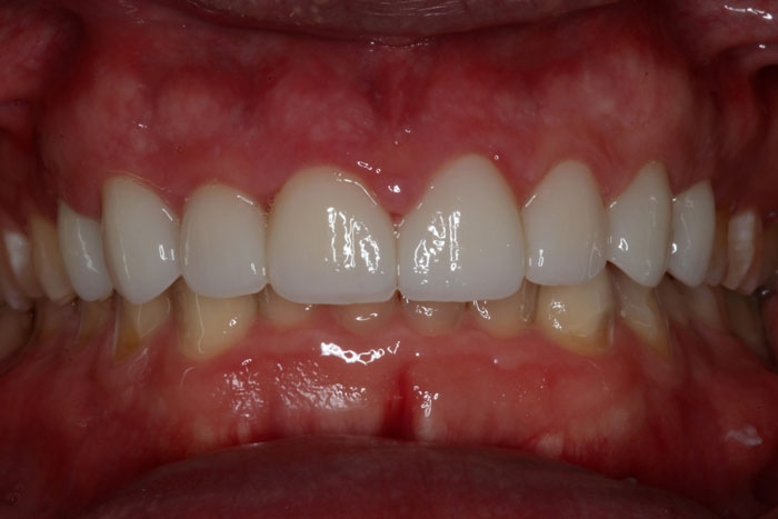 After Image: Crowns - front