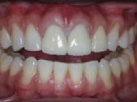 After Image: Crowns - front