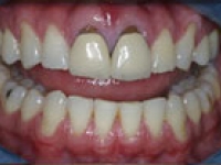 Before Image: Crowns