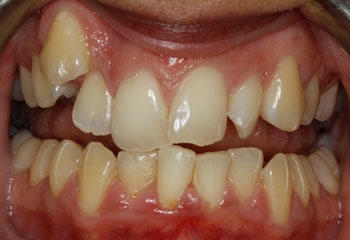 Before Image: Orthodontics - front