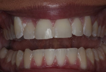 After Image: Orthodontics - front