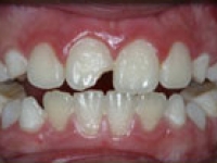 Before Image: Dental Bonding