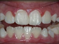 After Image: Dental Bonding - front