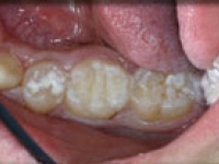 After Onlays Fillings Las Vegas NV