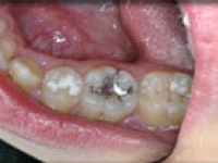 before Onlays Fillings Las Vegas NV
