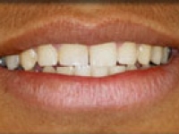 After Image: Onlays - front