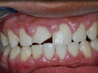 Before Image: Onlays