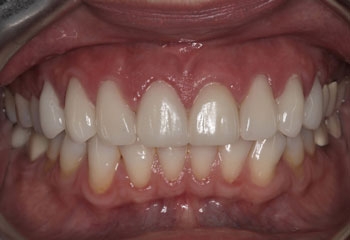 After Image: Porcelain Veneers - front