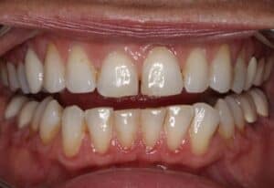 Porcelain Veneers