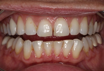 Before Image: Porcelain Veneers - front