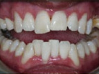 After Image: Bleaching and Whitening - front
