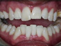 Bleaching and Whitening