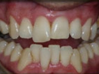 Before Image: Bleaching and Whitening - front