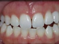 After Image: Bleaching and Whitening - front
