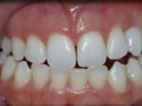 Bleaching and Whitening