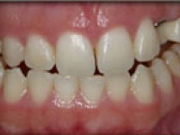 Before Image: Bleaching and Whitening
