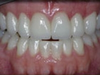 After Image: Porcelain Veneers - front
