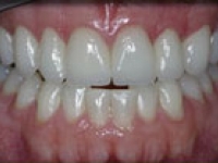 Porcelain Veneers