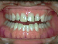 Before Image: Porcelain Veneers - front