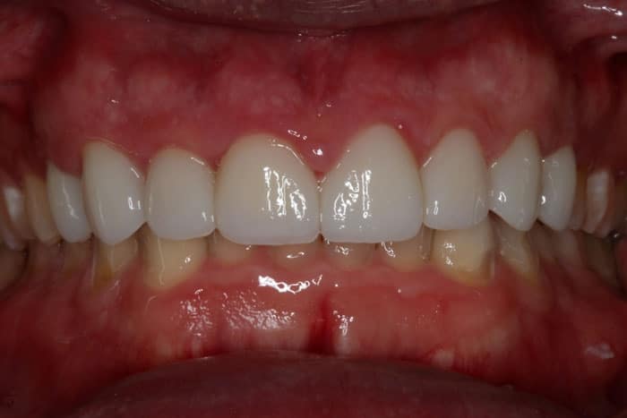after Dental Crowns Las Vegas NV