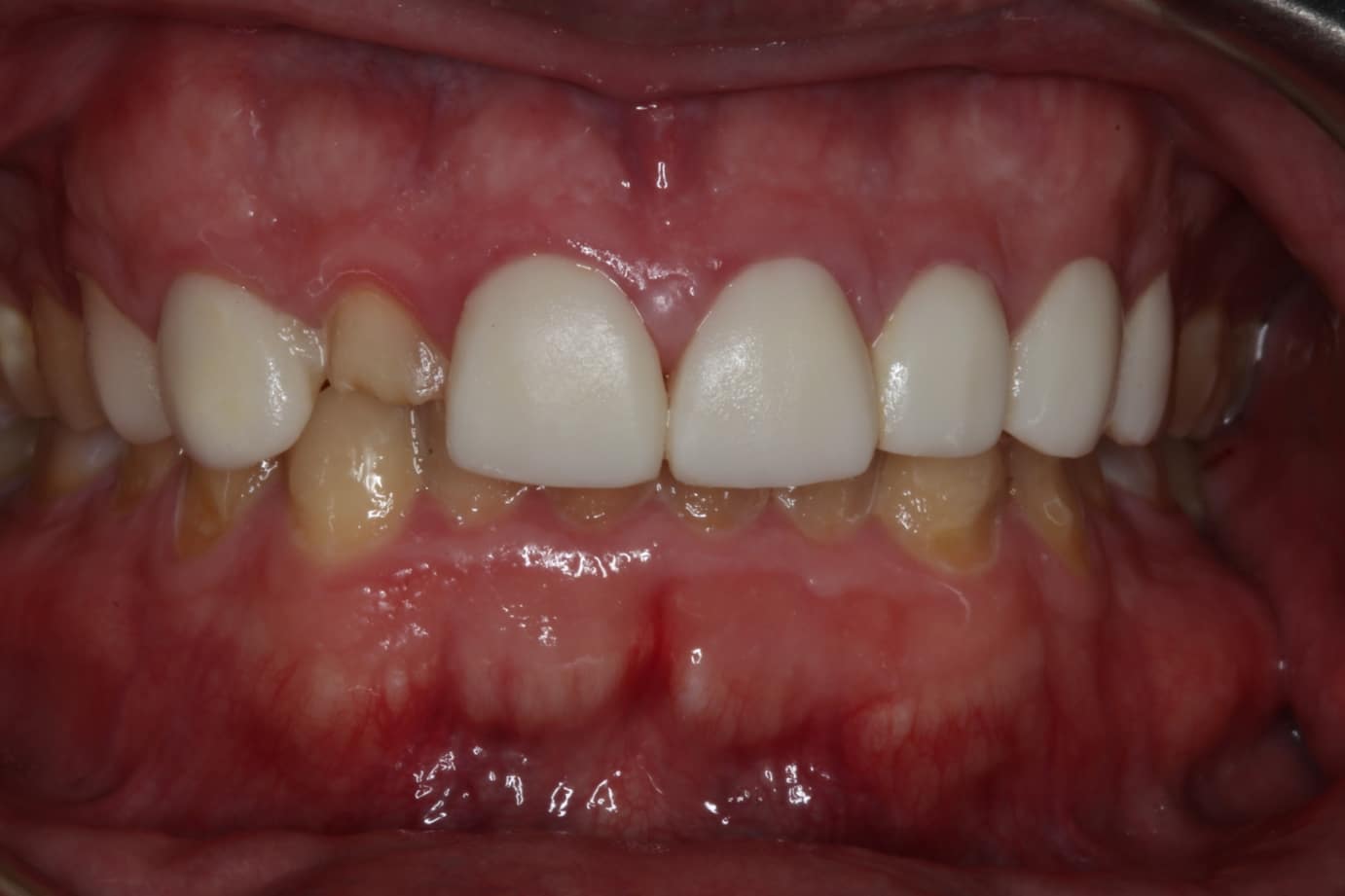 before Dental Crowns Las Vegas NV