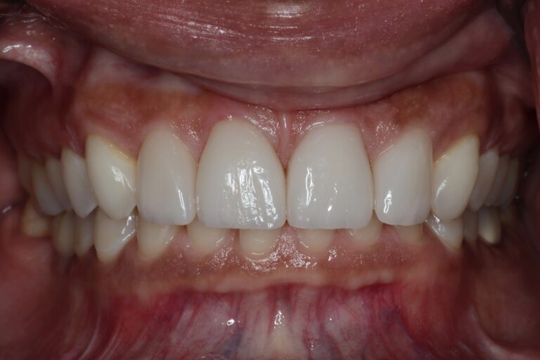 After Image: Veneers - front