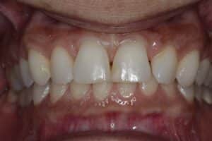 Veneers