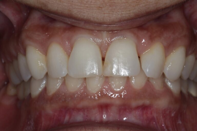Before Image: Veneers - front