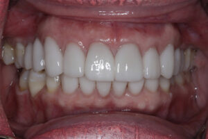 Veneers