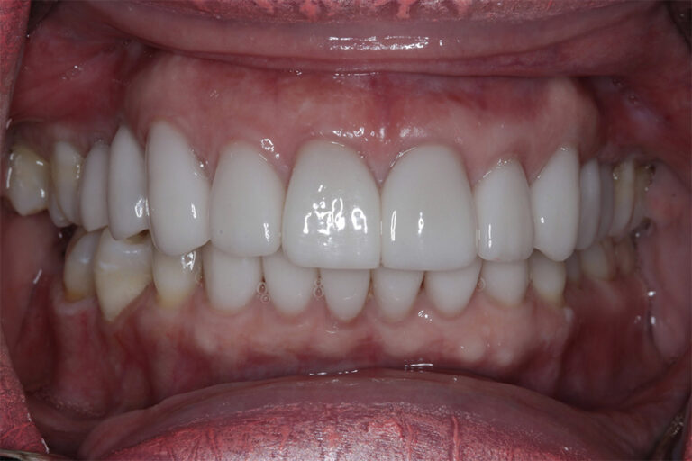 After Image: Veneers - front