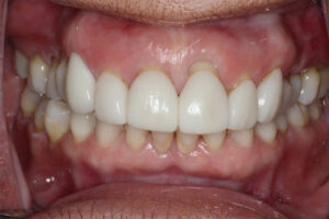 Before Image: Veneers