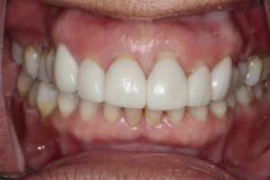 Veneers