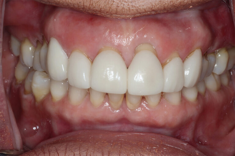 Before Image: Veneers - front