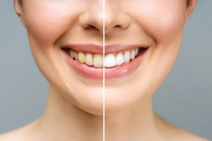 Professional teeth whitening