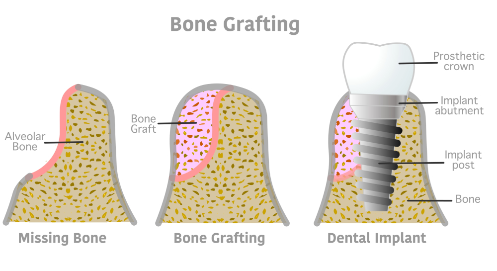 Tooth Implants Las Vegas NV