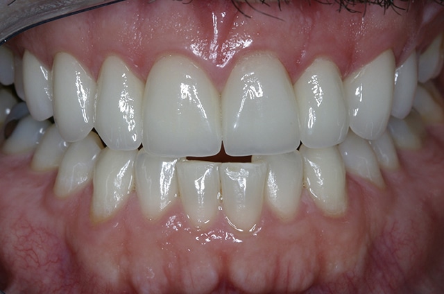 After Image: Veneers - front