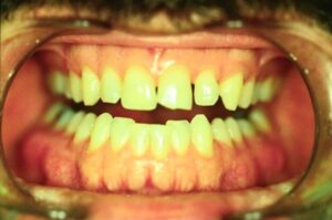 Before Image: Veneers