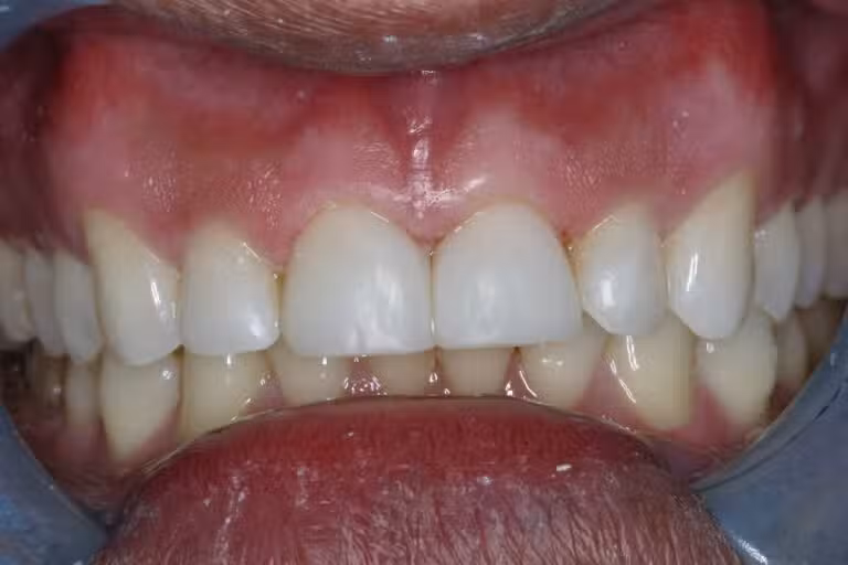 After Image: Bonding - left-front-oblique