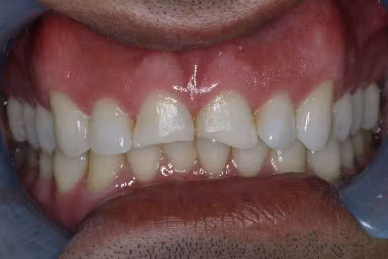Before Image: Bonding - left-front-oblique