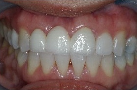 After Image: Veneers - front