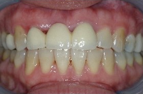 Before Image: Veneers